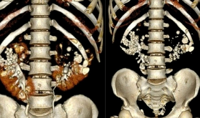 Soda addiction Hundreds of stone corn grains are embedded in the kidneys of people in their 30s