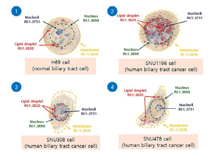 Developing the world's first AI-based cholangiocarcinoma cell diagnosis technology...Accuracy 98.6%