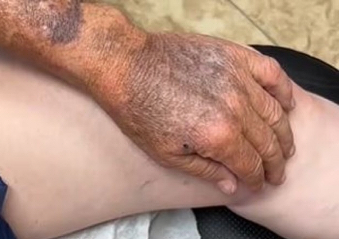 Why don't you put on sunscreen if it's like this?Men exposed to arms for 70 years, shock skin