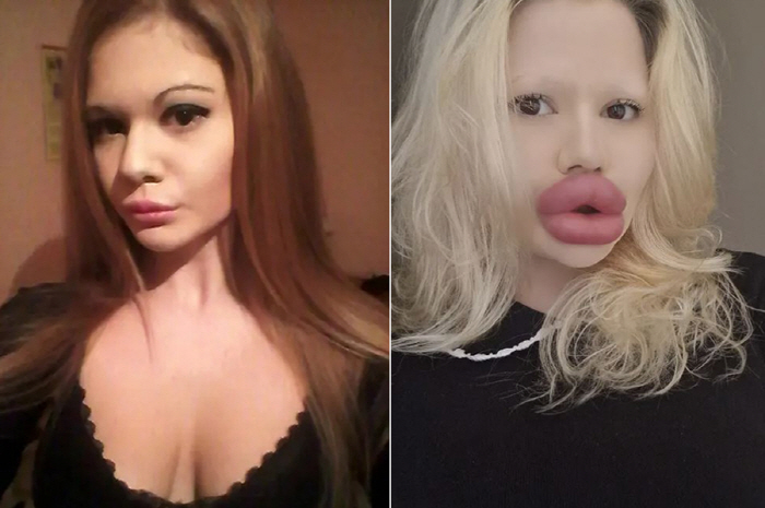 World's Biggest Lip Female Plastic Surgery Revealed...I know why you can't date