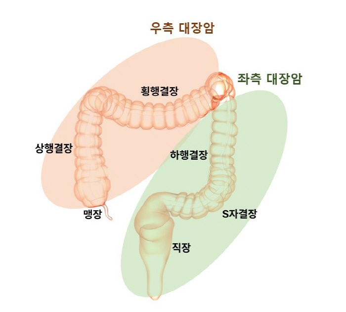 More than half of female colorectal cancer is on the right side...The path of cancer is different