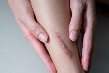Hypertrophic scars afflicting burn patients open up treatment possibilities due to methionine restrictions