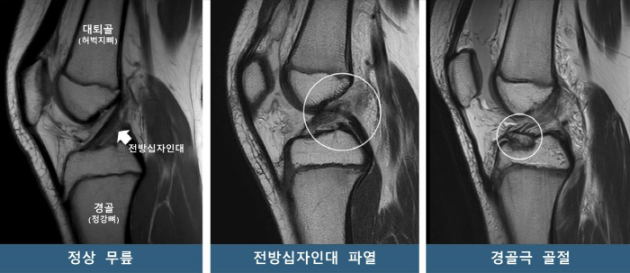 Children and adolescents' knees are different depending on their natural shape