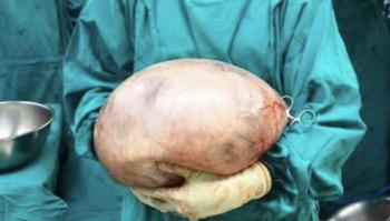 I thought I had a belly because I was fat… 30cm Size 8kg Ovarian Tumor Found