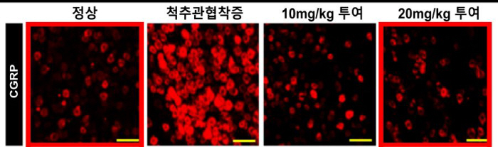 Abstraction Effect of Placenta Extract on the Treatment of Degenerative Spinal Diseases