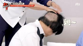 Hair transplant Choi Yang-rak planted 5,000 hairs exposed on the back of his injured head before his son, a prestigious university (No. 1)