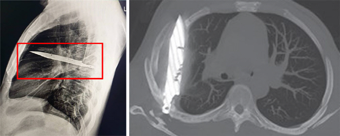 A man who lived with a blade in his chest for 8 years, lived without any inconvenience...
