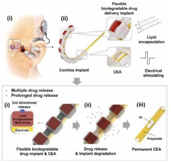 Development of implant to reduce hearing damage due to side effects of artificial woo surgery