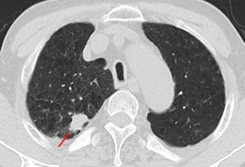 Men Over 70 Years Old Confirm Early Detection Of Lung Cancer With Low-Dose CT