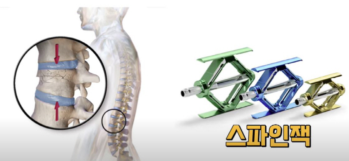 Himchan Hospital Introduces New Treatment for Spinal Compression Fractures...Effective for patients with acute phase and osteoporosis, etc