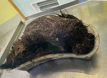 A bunch of melon-sized hair inside a teenage girl's belly...It's been building up for years