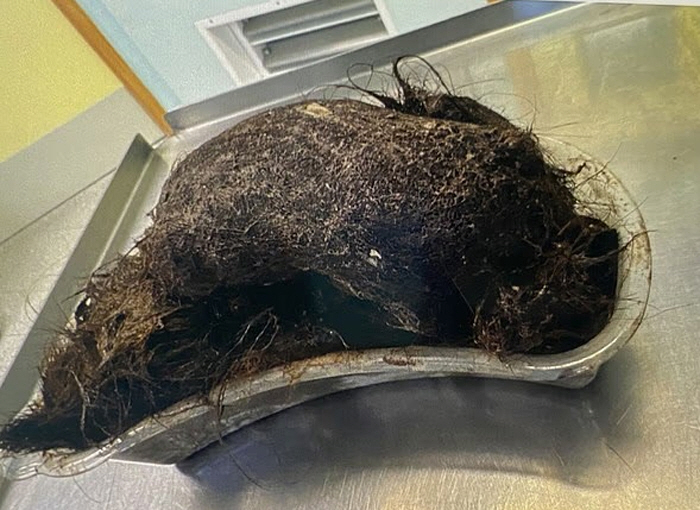 A bunch of melon-sized hair inside a teenage girl's belly...It's been building up for years