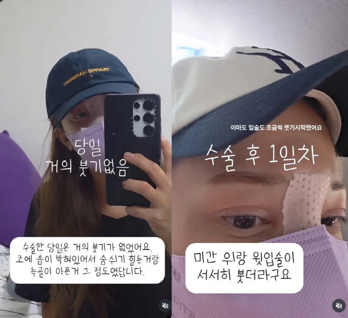 Lee Yong-gyu ♥ Yoo Ha-na, the real review of nose reoperation after 20 years...It's Kobong, but I'm satisfied