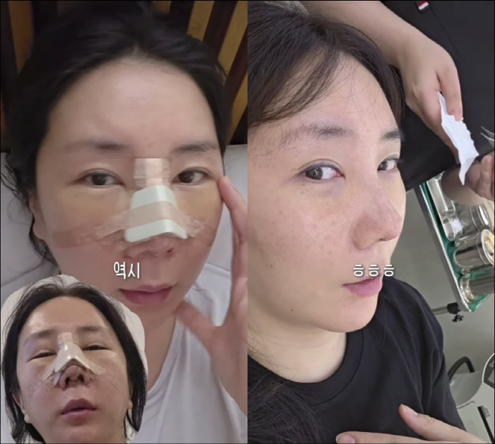 Anna's nose reconstruction is a big success...Amazing before and after cuteness has disappeared