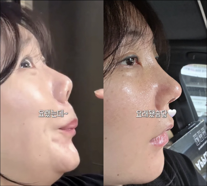 Anna's nose reconstruction is a big success...Amazing before and after cuteness has disappeared