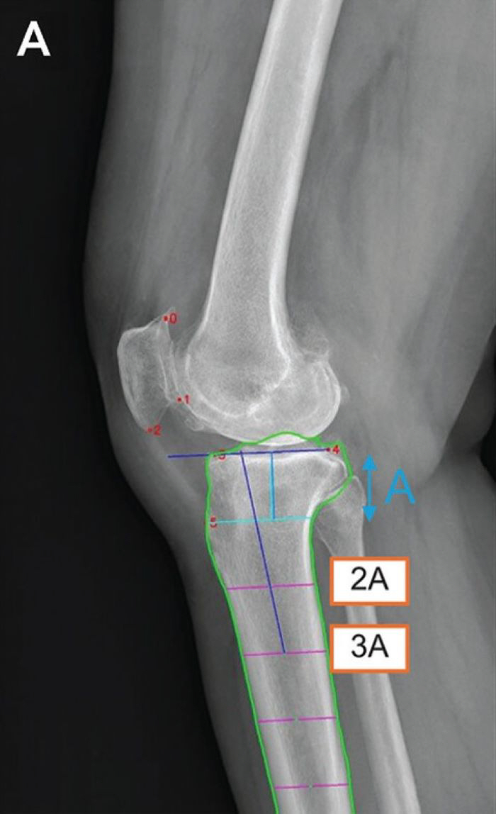Automatic measurement of prognosis for AI-based knee surgery...It's 10 times faster than a specialist