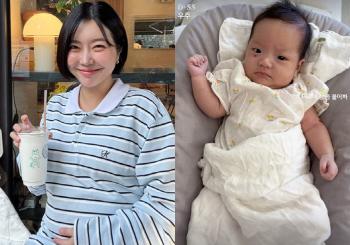 Lady Jane, just a month after giving birth to twins..a clear sub-eye hemangioma