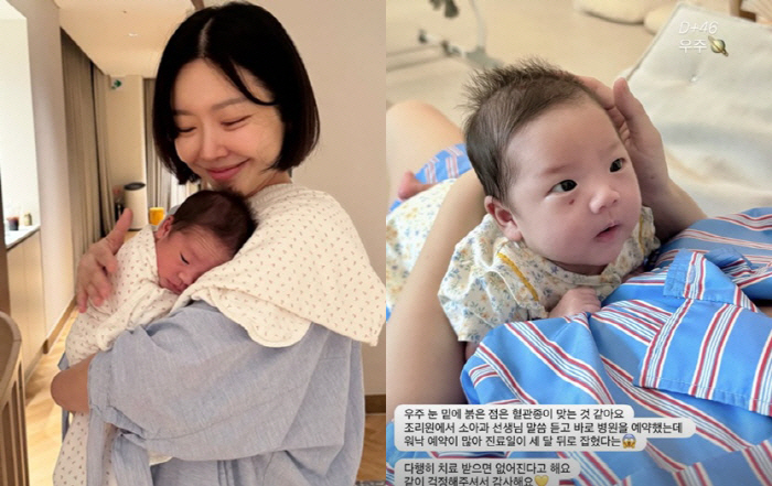 Lady Jane, just a month after giving birth to twins..a clear sub-eye hemangioma