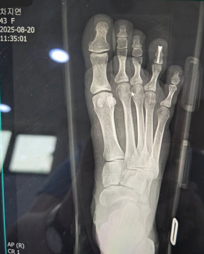 Cha Ji-yeon reveals her toe with a broken toe and a threaded toe...I want you back as soon as possible