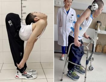 A folder boy with a 180-degree bent waist, finally stood upright...a feeling of rebirth