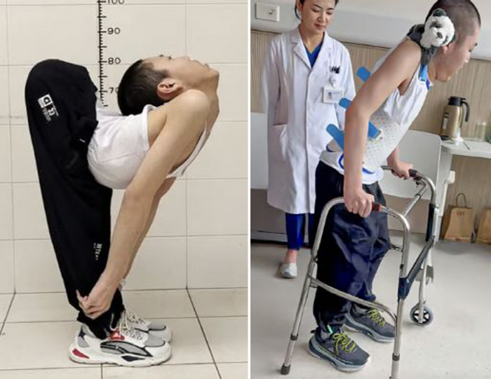 A folder boy with a 180-degree bent waist, finally stood upright...a feeling of rebirth