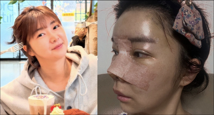 After breaking up with Young-ja, Mr. Hwang, you don't have to hide your eye and nose plastic surgery
