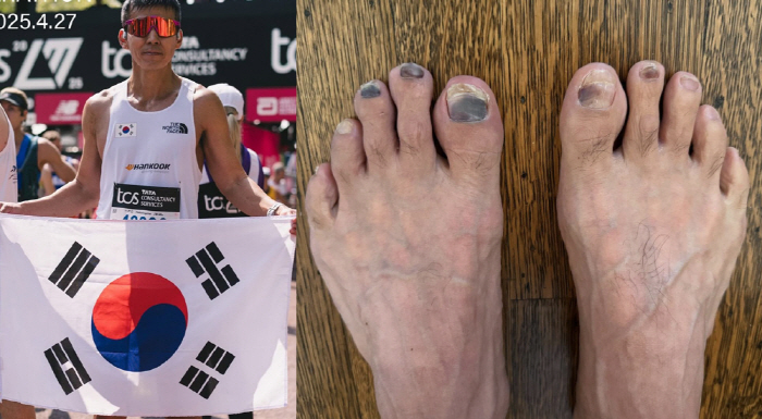 Sean, 52, is in serious foot condition after the Liberation Day marathon..