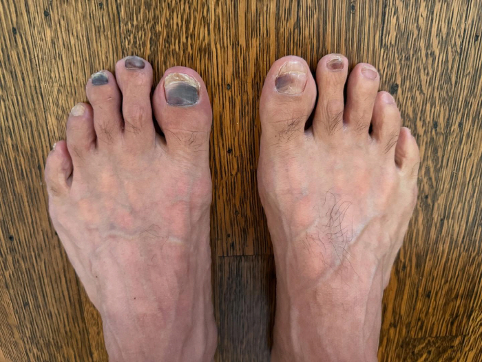53 years old, black toenails...It's a black and blue trophy, but it's a glorious trophy