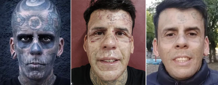 95% tattooed male of body for 20 years, why he's getting a sudden removal procedure