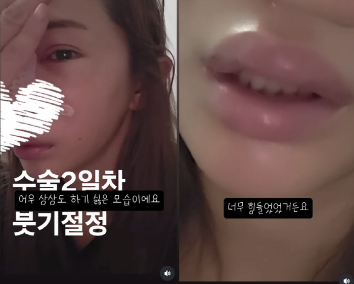Lee Yong-gyu ♥ Yoo Ha-na, re-operation for the nose for the first time in 20 years..My lips are swollen and I'm crying
