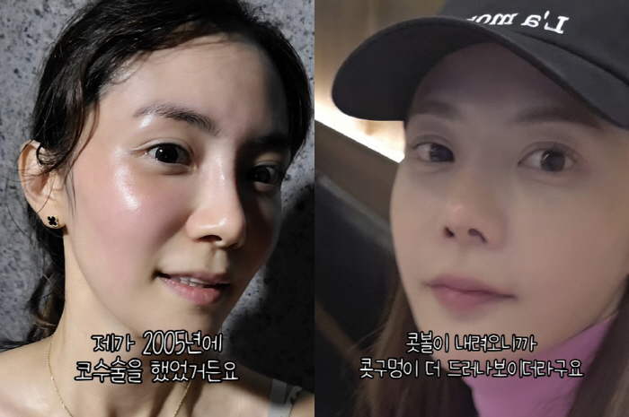 Lee Yong-gyu ♥ Yoo Ha-na, re-operation for the nose for the first time in 20 years..My lips are swollen and I'm crying