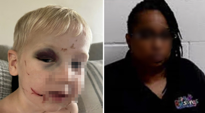 A bruised eye, a deep wound. Who would do this to a child... Anger at the release of the perpetrator on bail