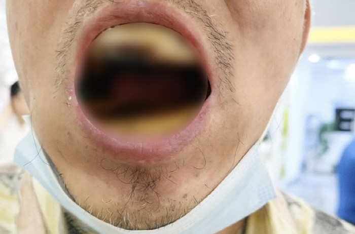 To save dental expenses, make self dentures, pull out all teeth...