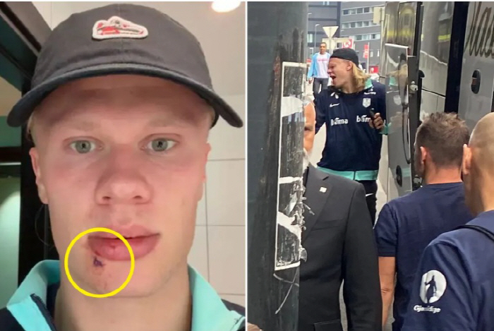 Who hit me? Hollan, hit the bus, three stitches...I was beaten by Oedegaard. Even with the pain, I smiled