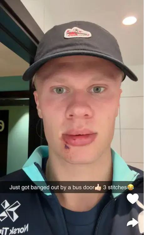 Man City Hallan's Injured! Shock on the bus door → I can't tear my mouth, so I sew three needles...This is the first time I've ever done this