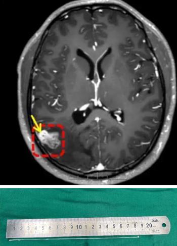 18cm parasite wriggle in my brain, I was surprised to see what I ate