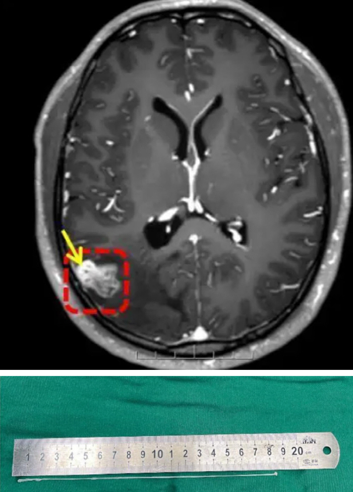 18cm parasite wriggle in my brain, I was surprised to see what I ate