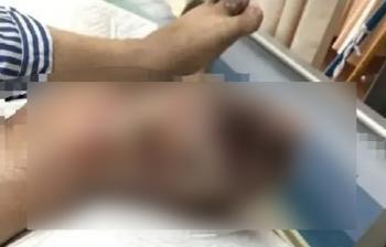 Man Who Was Drinking 3 cans of Coke Every Day, Almost Got His Foot amputated...because of this disease