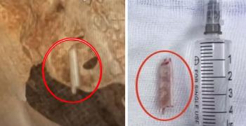 Woman with a thermometer stuck in her hip for 22 years, remembering...