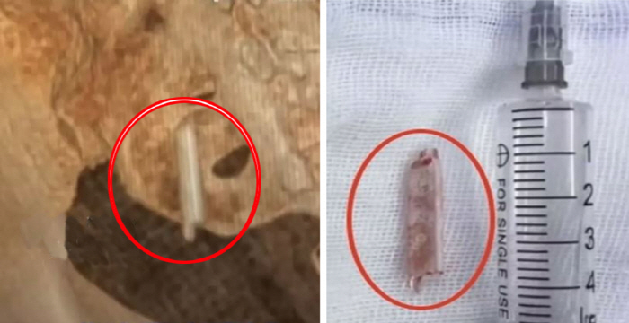 Woman with a thermometer stuck in her hip for 22 years, remembering...