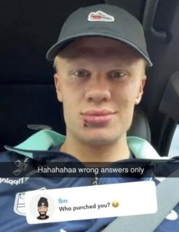 What's wrong with her lips?Who hit you? Manchester City's one-top lip injury update ahead of Manchester United match