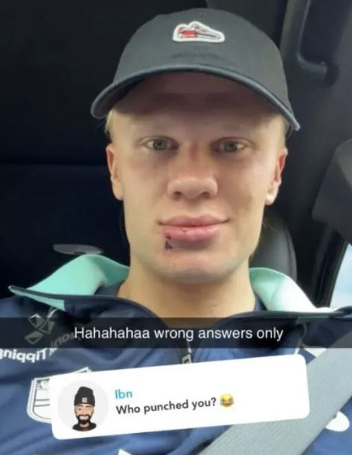 What's wrong with her lips?Who hit you? Manchester City's one-top lip injury update ahead of Manchester United match