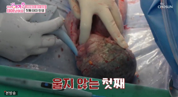 Four twins gave birth, 20 medics, but..All four of us are in the intensive care unit without crying (baby baby) 