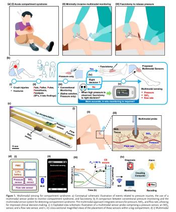 Early diagnosis of emergency disease acute compartment syndrome Micro multimodal sensor developed for the first time in the world