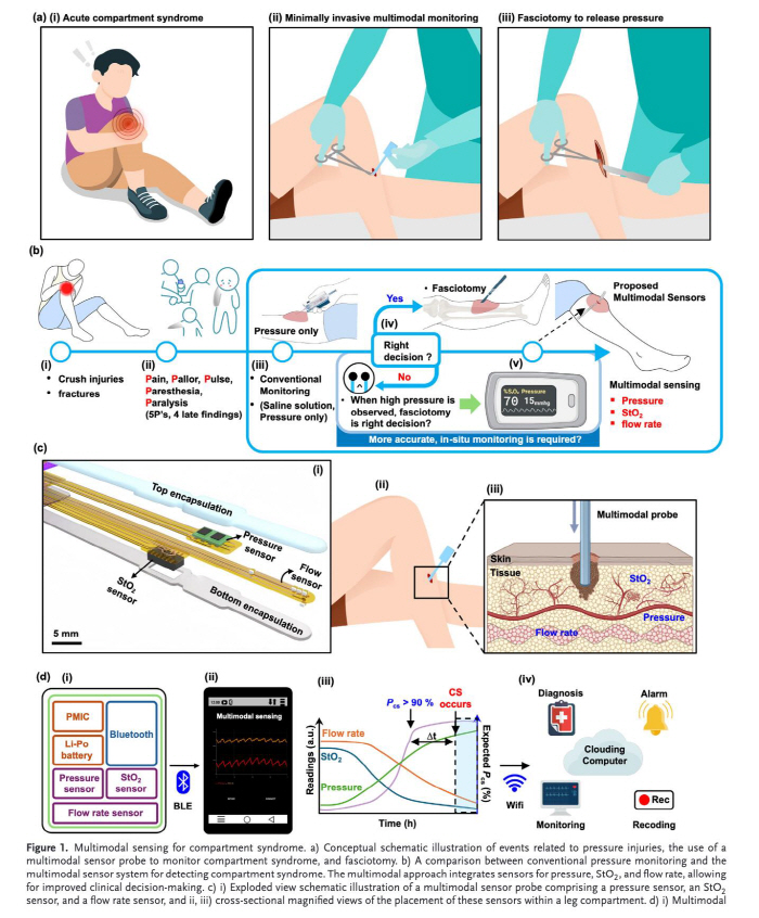 Early diagnosis of emergency disease acute compartment syndrome Micro multimodal sensor developed for the first time in the world