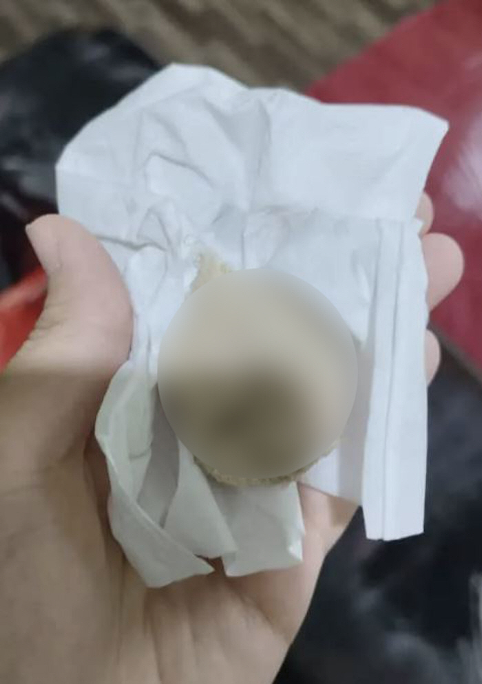 Pain for a month after giving birth, lumps of gauze coming out of genitalia...legal action review