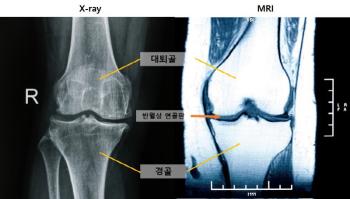 Early diagnosis of knee arthritis confirms new MRI indicators