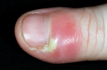 I unwittingly tore off the rubble around my nails, and I was diagnosed with perigastric gastritis