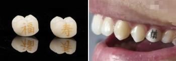 200,000 won per MZ generation tooth tattoo is in vogue...I'm afraid it might break