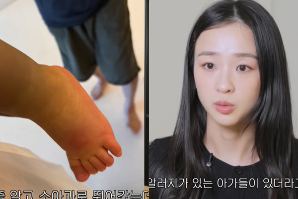 Son Yeon-jae, 'Inflammation and pus from 20 bites on the face'.. Mosquito allergy, 'Heart throbbing.'